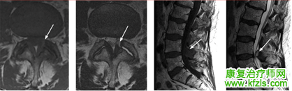 腰椎MRI