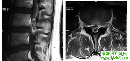 腰椎MRI