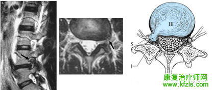 腰椎MRI