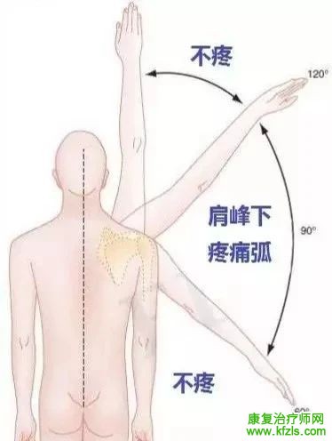 冈上肌肌腱炎的康复训练指南