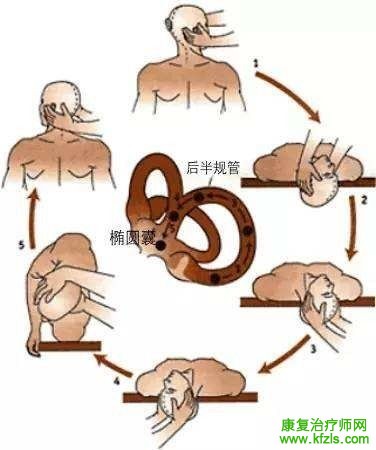 耳石症的康复训练