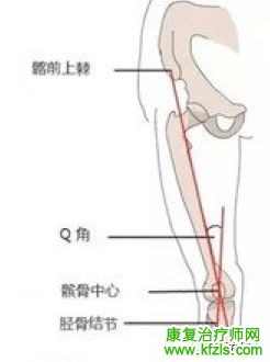 矫形鞋垫对X/O型腿的矫治方法