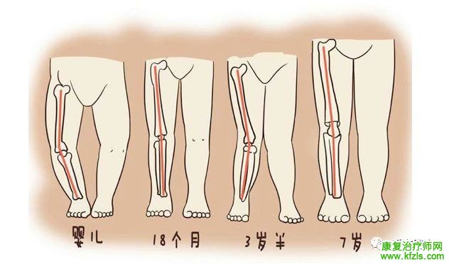 矫形鞋垫对X/O型腿的矫治方法