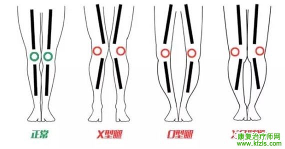 矫形鞋垫对X/O型腿的矫治方法