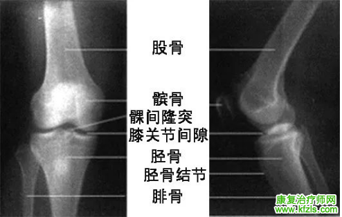 髌骨骨折的治疗与康复计划