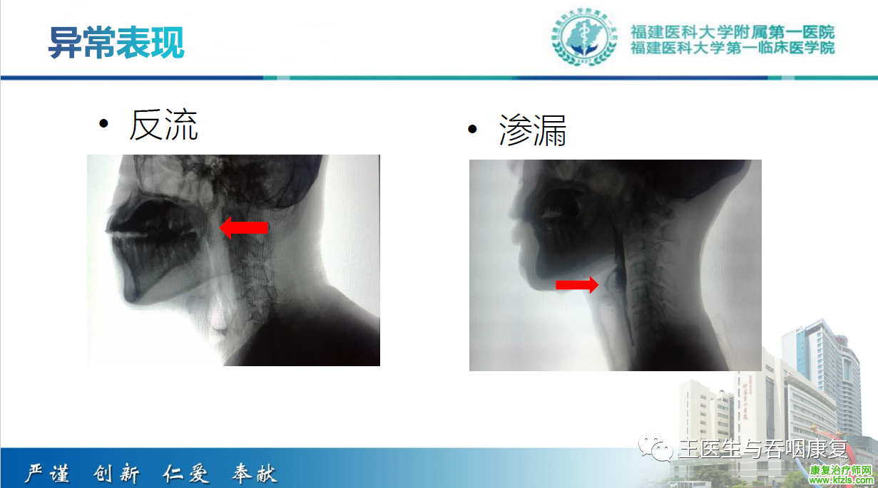 吞咽造影评估技术