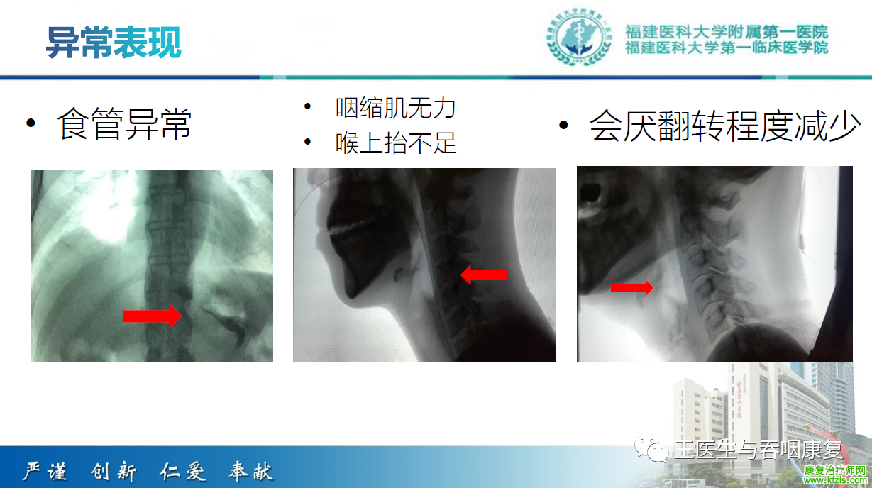 吞咽造影评估技术