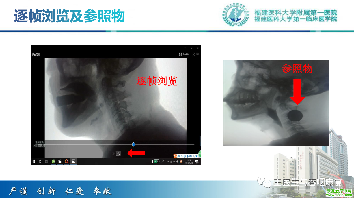 吞咽造影评估技术