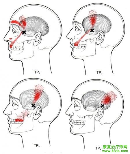 28块肌肉激痛点以及疼痛模式