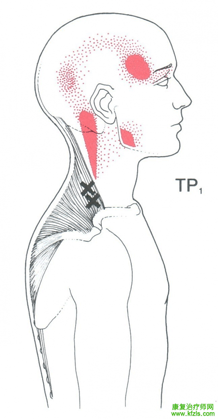 28块肌肉激痛点以及疼痛模式
