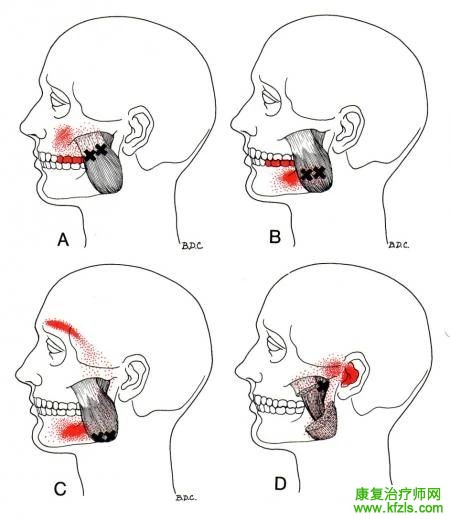 28块肌肉激痛点以及疼痛模式