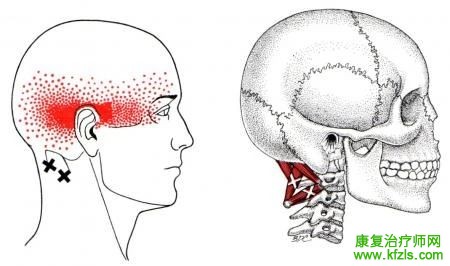 28块肌肉激痛点以及疼痛模式