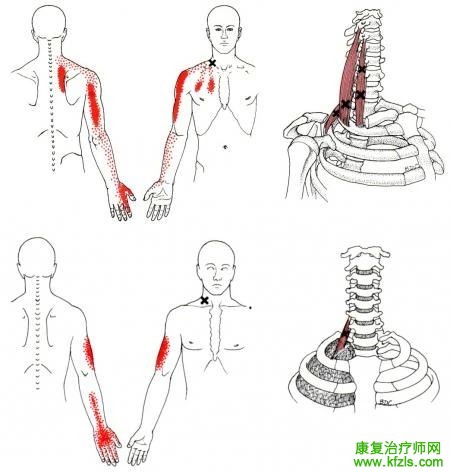 28块肌肉激痛点以及疼痛模式