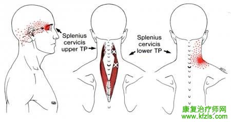 28块肌肉激痛点以及疼痛模式