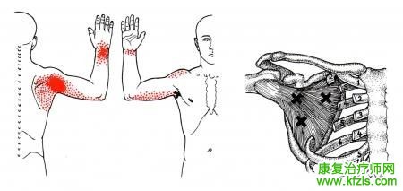 28块肌肉激痛点以及疼痛模式