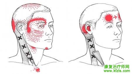 28块肌肉激痛点以及疼痛模式