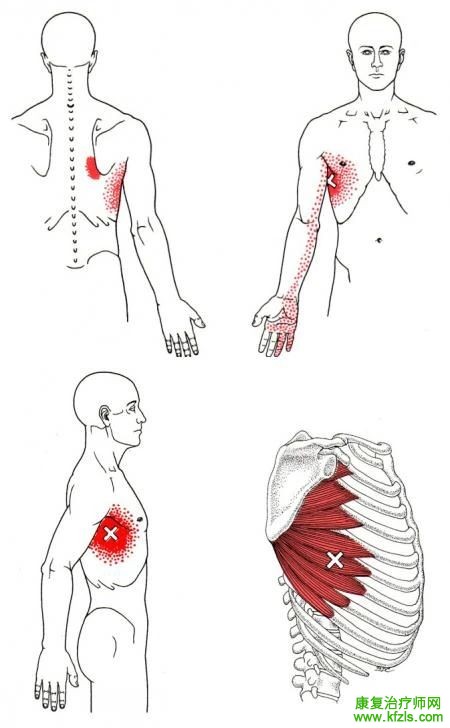28块肌肉激痛点以及疼痛模式