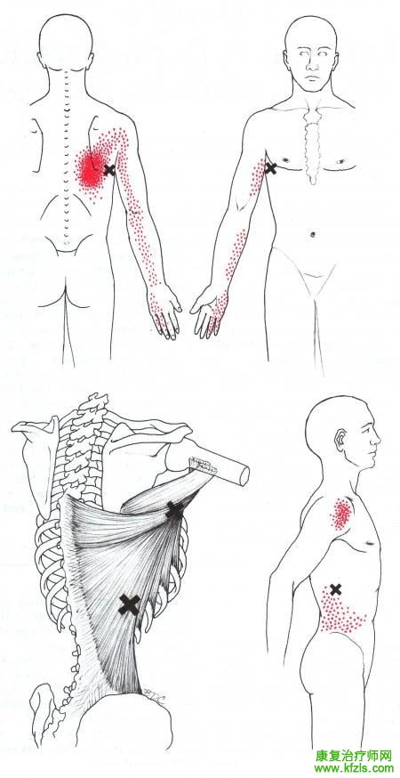 28块肌肉激痛点以及疼痛模式