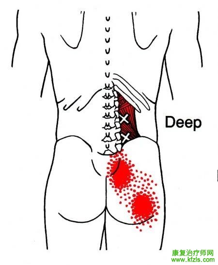 28块肌肉激痛点以及疼痛模式