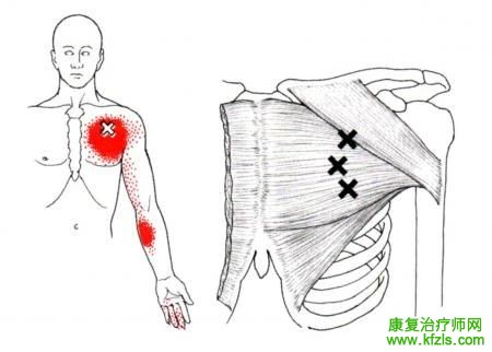 28块肌肉激痛点以及疼痛模式