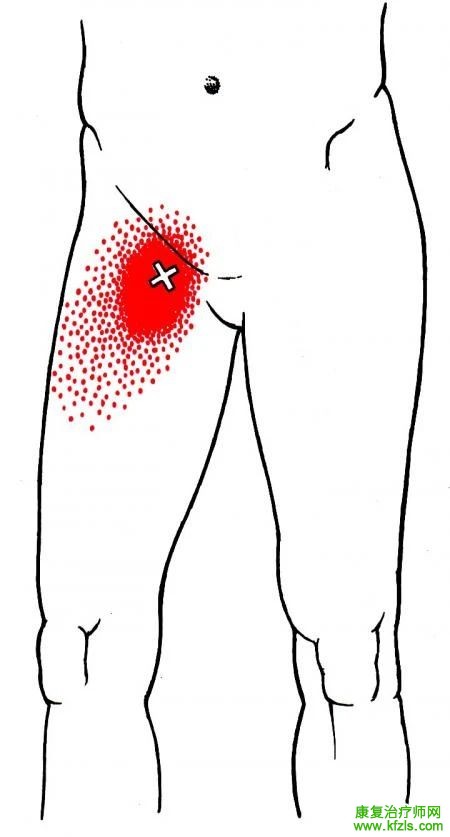28块肌肉激痛点以及疼痛模式
