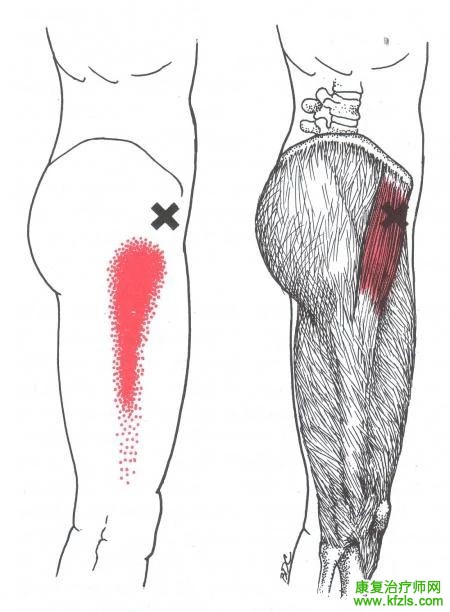 28块肌肉激痛点以及疼痛模式