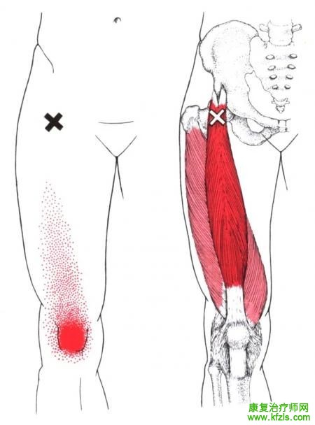 28块肌肉激痛点以及疼痛模式