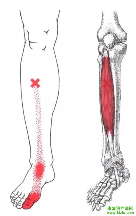 28块肌肉激痛点以及疼痛模式