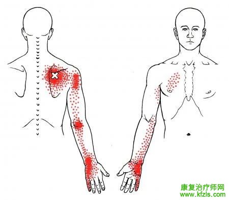 28块肌肉激痛点以及疼痛模式