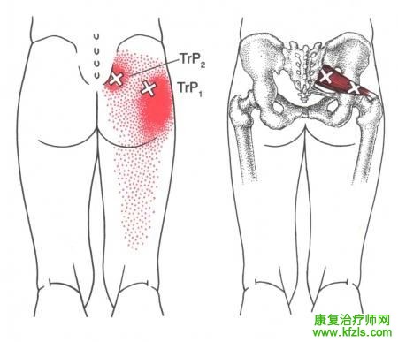 28块肌肉激痛点以及疼痛模式