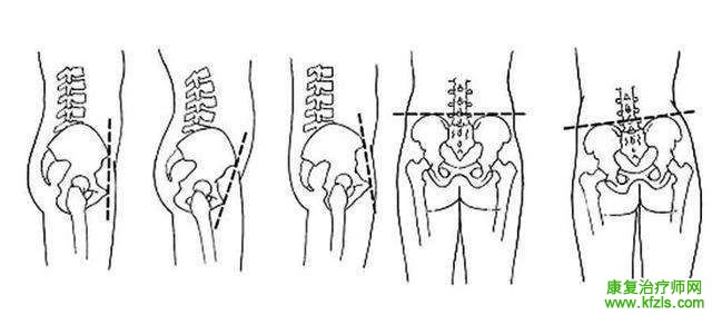 收藏！骨盆前后、上下倾斜的康复治疗！