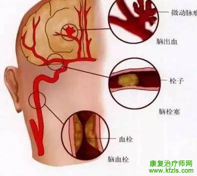 脑梗塞、脑血栓、脑出血的区别！