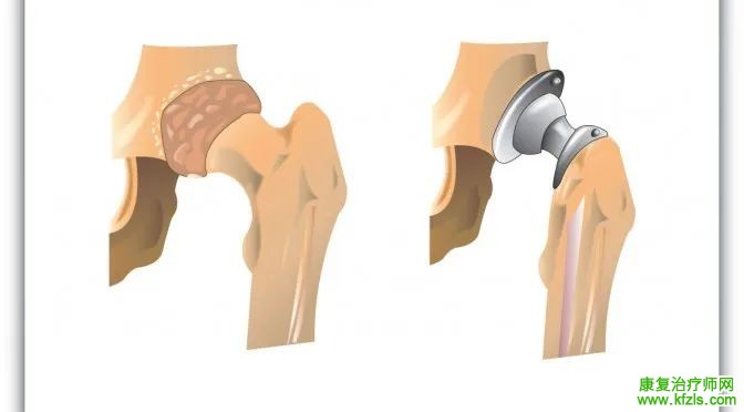 全面讲解髋关节置换术后的康复训练！