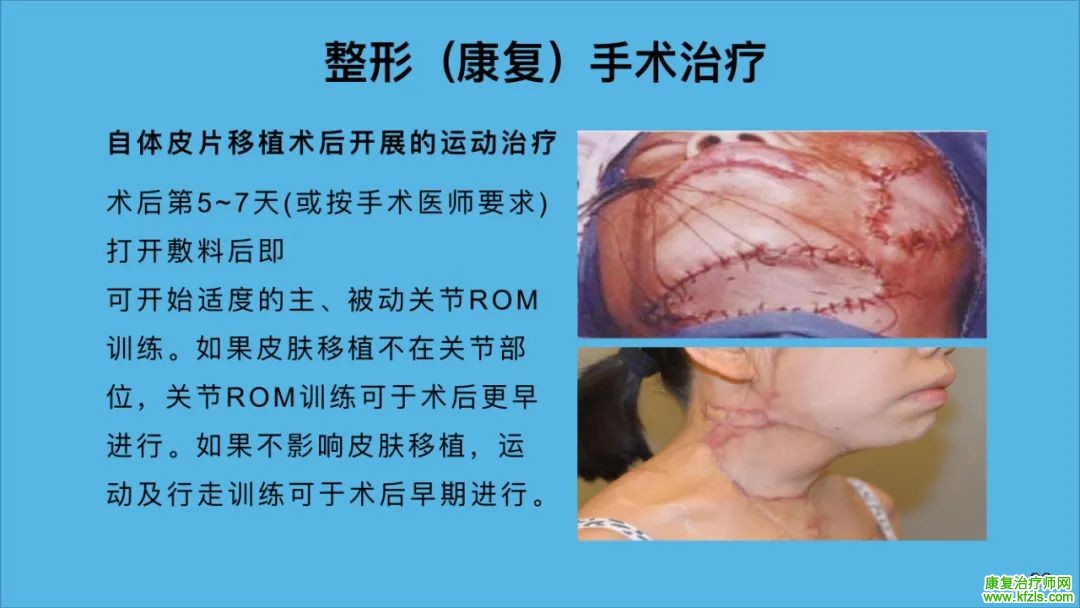 烧伤的康复治疗​怎么做？