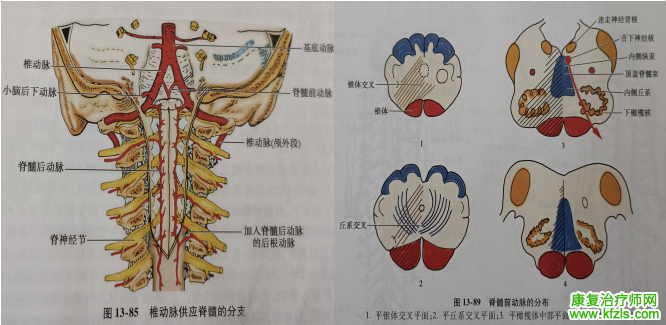 脑干梗死