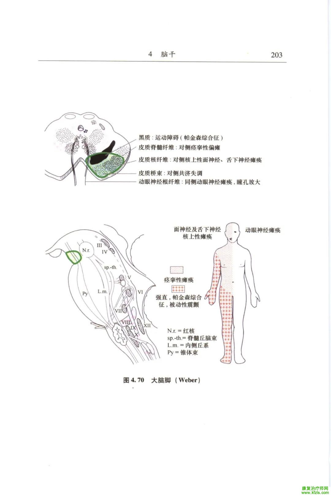 脑干梗死