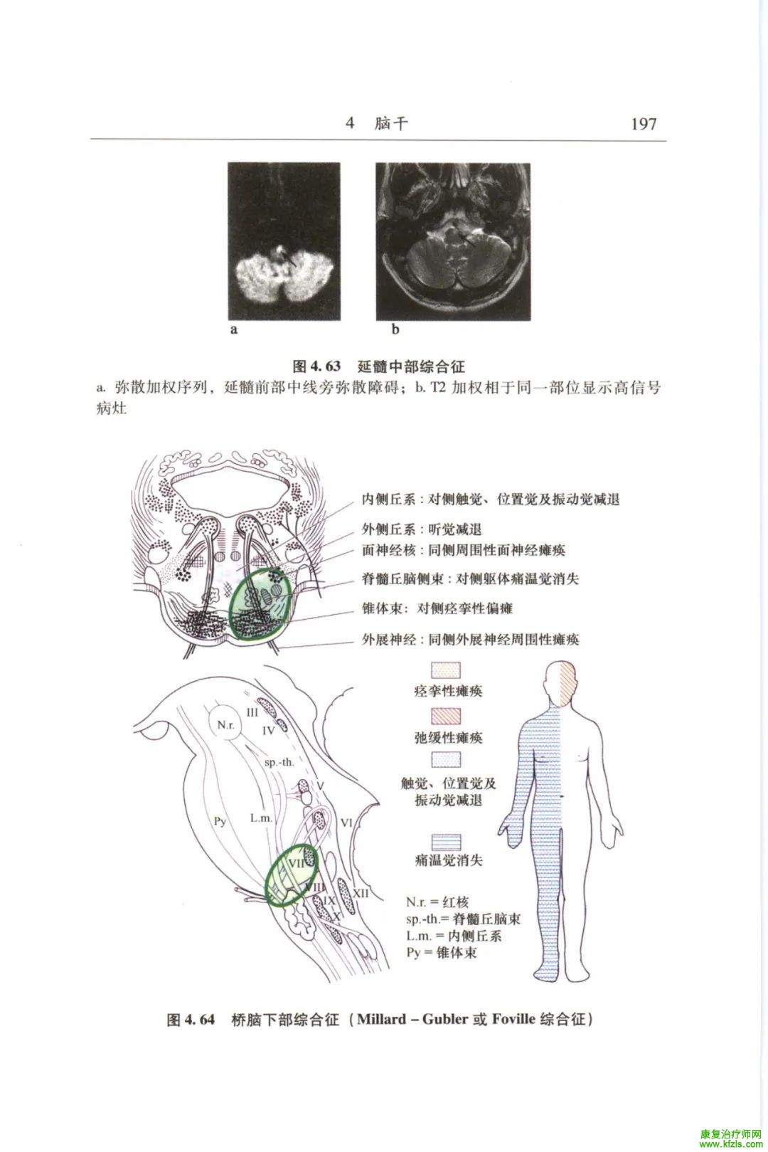 脑干梗死