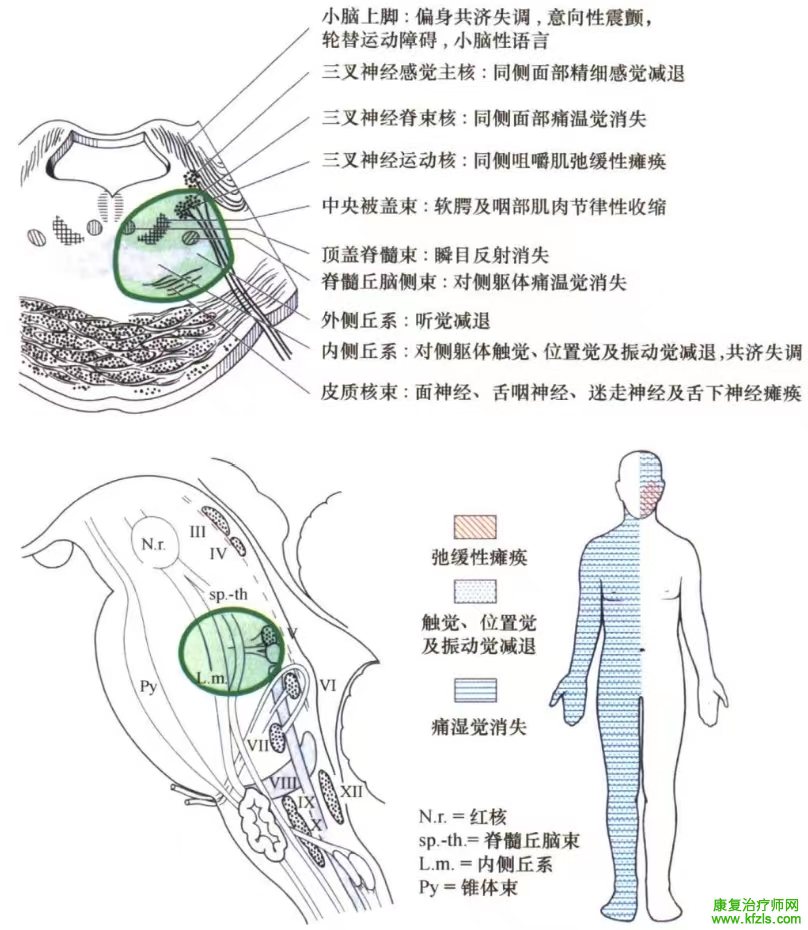 脑干梗死