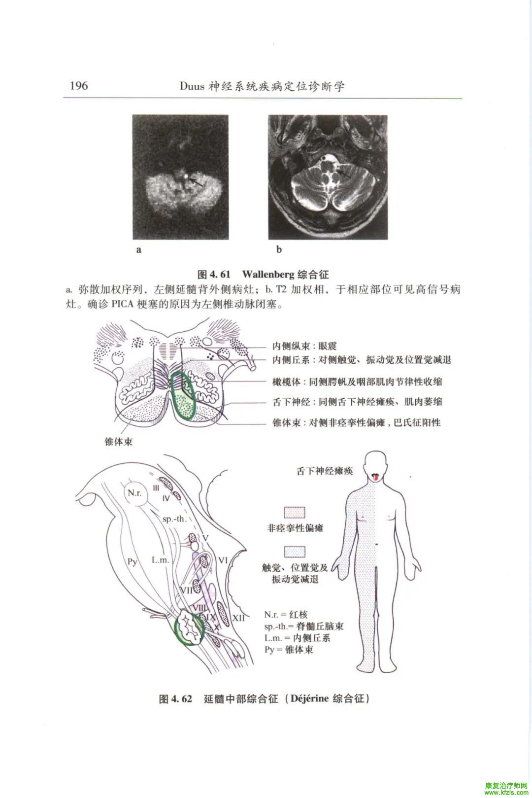 脑干梗死