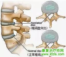 腰间盘突出康复治疗的12种方法