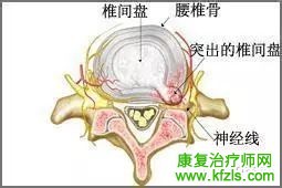 腰间盘突出康复治疗的12种方法