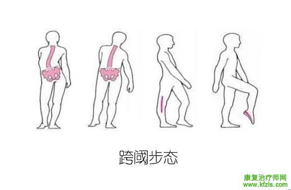 10张图带你秒懂步态分析