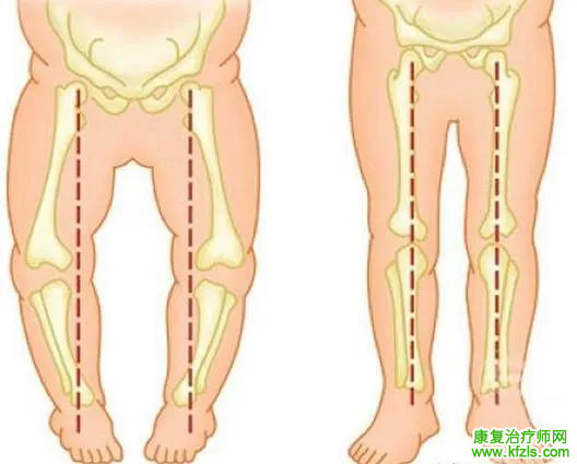 “O”型腿及矫正方法