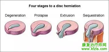 椎间盘突出的康复训练