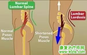 椎间盘突出的康复训练