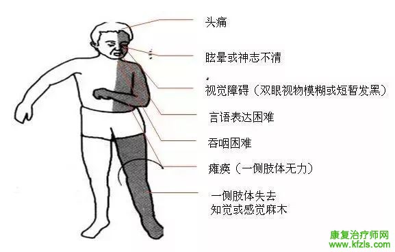 脑卒中康复治疗