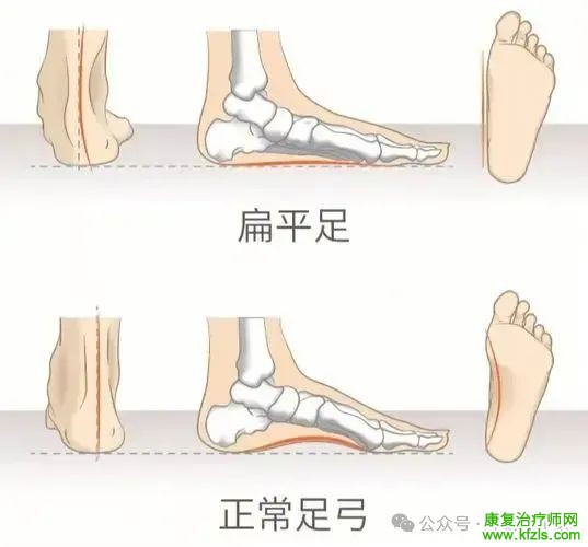 扁平足